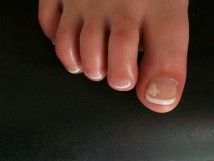 Proth&egrave;ses ongulaires des pieds