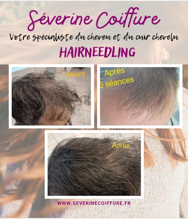 Le hairneedling capillaire à domicile avec Séverine Coiffure !