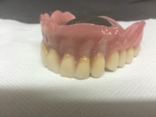 Proth&egrave;ses sur ch&acirc;ssis m&eacute;tallique